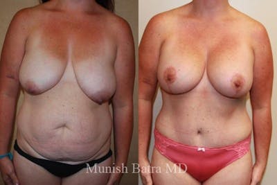 Breast Augmentation with Lift Mastopexy Before & After Gallery - Patient 193315 - Image 1