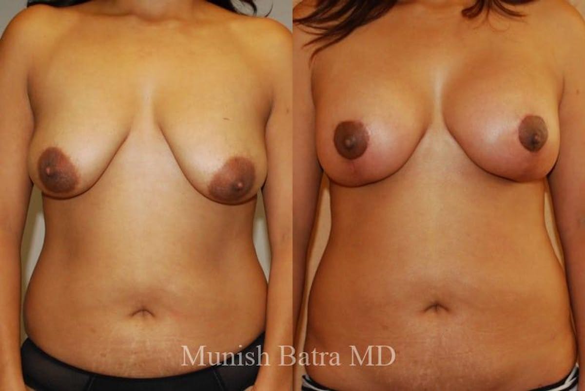 Breast Augmentation with Lift Mastopexy Before & After Gallery - Patient 104467 - Image 1