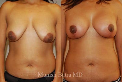 Breast Augmentation with Lift Mastopexy Before & After Gallery - Patient 104467 - Image 1