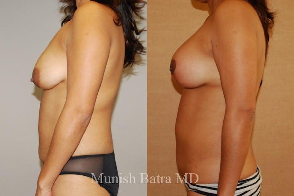 Breast Augmentation with Lift Mastopexy Before & After Gallery - Patient 104467 - Image 2