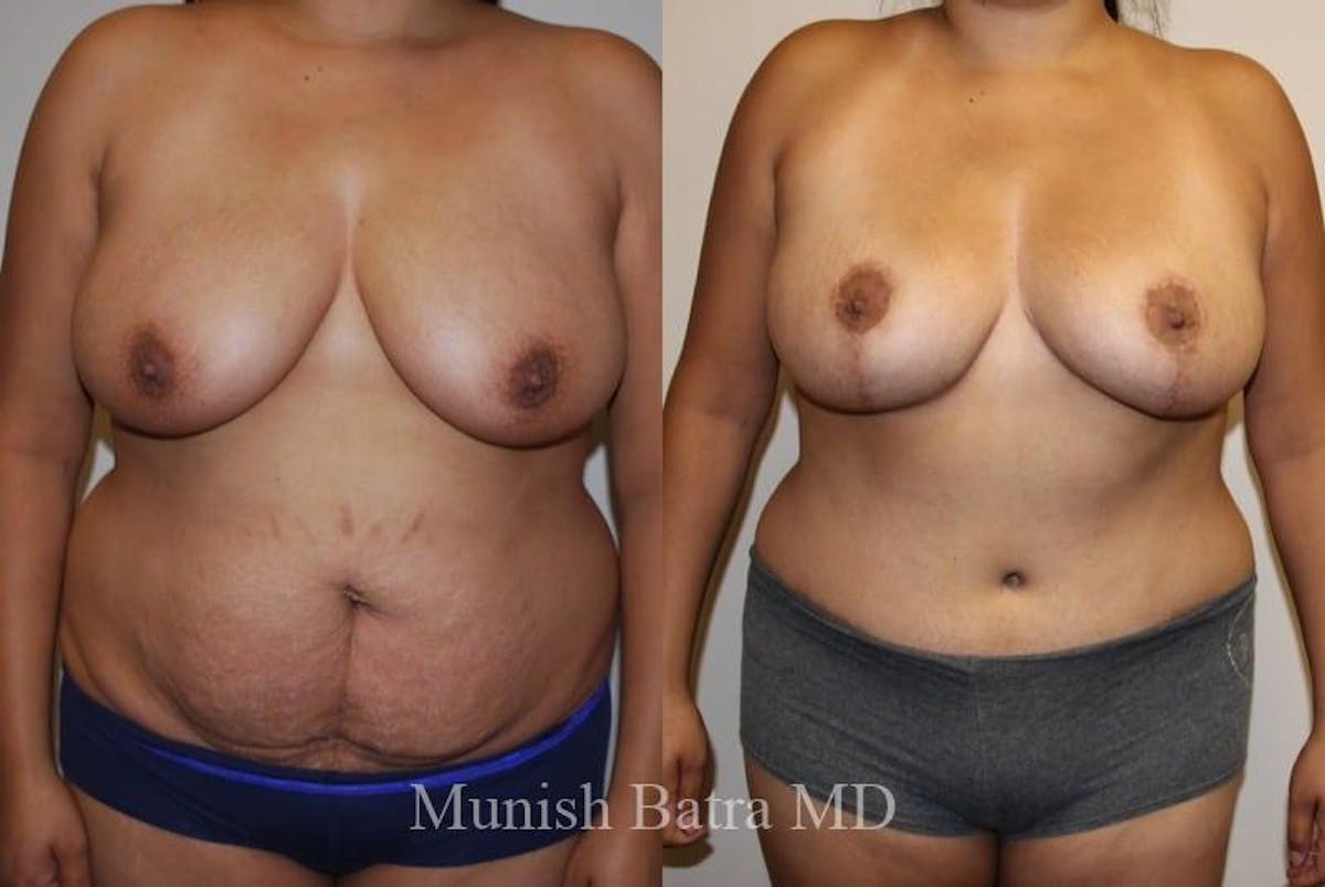 Breast Augmentation with Lift Mastopexy Before & After Gallery - Patient 261560 - Image 1