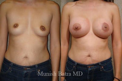 Breast Augmentation with Lift Mastopexy Before & After Gallery - Patient 318852 - Image 1