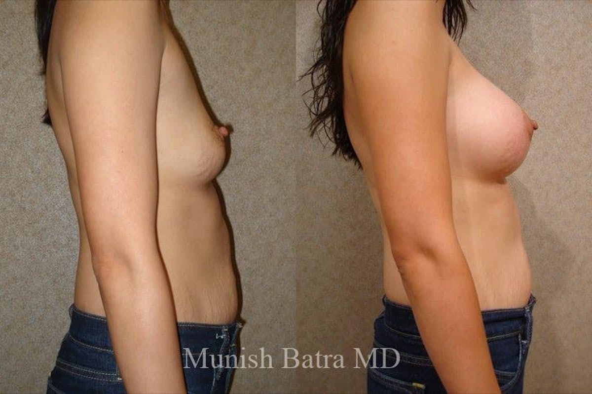 Breast Augmentation with Lift Mastopexy Before & After Gallery - Patient 318852 - Image 2