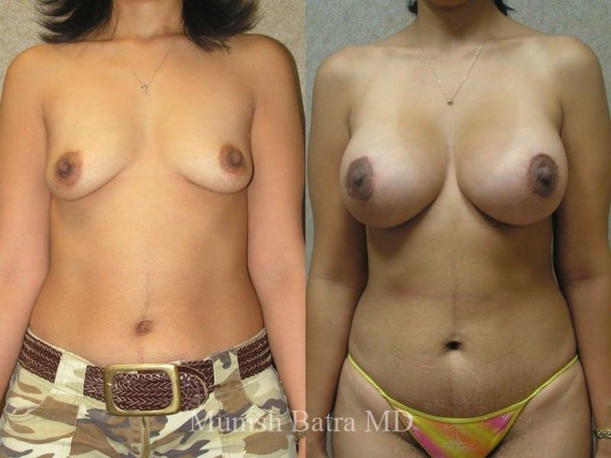 Breast Augmentation with Lift Mastopexy Before & After Gallery - Patient 759176 - Image 1