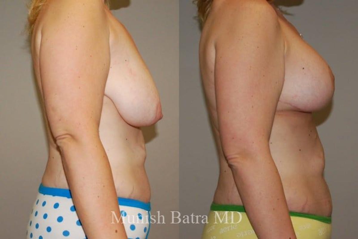 Breast Augmentation with Lift Mastopexy Before & After Gallery - Patient 117515 - Image 1