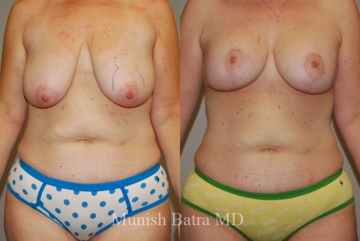 Breast Augmentation with Lift Mastopexy Before & After Gallery - Patient 117515 - Image 2
