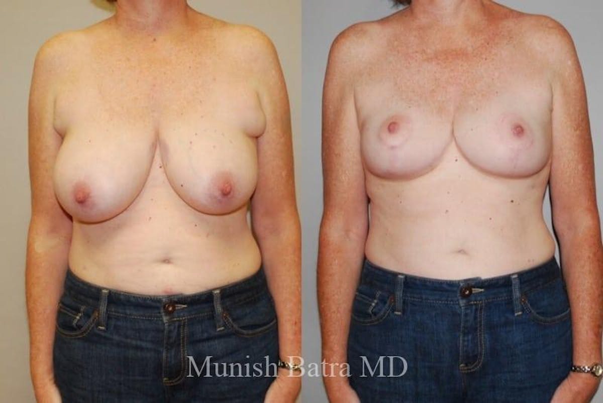 Breast Augmentation with Lift Mastopexy Before & After Gallery - Patient 372951 - Image 1