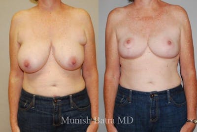 Breast Augmentation with Lift Mastopexy Before & After Gallery - Patient 372951 - Image 1