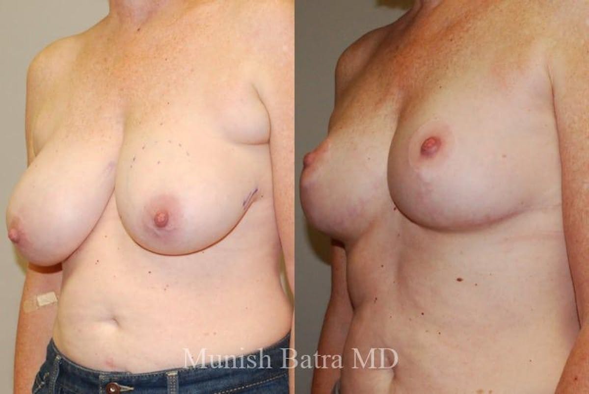 Breast Augmentation with Lift Mastopexy Before & After Gallery - Patient 372951 - Image 2