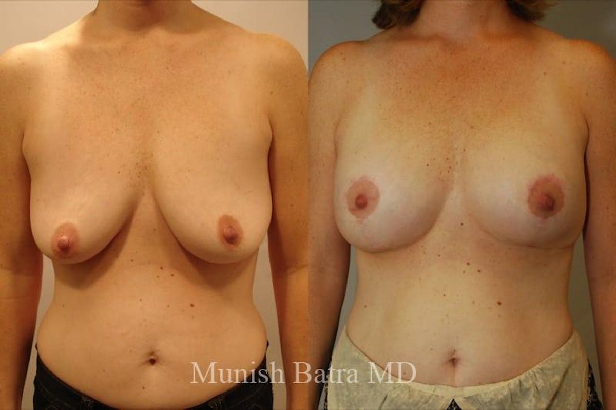 Breast Augmentation with Lift Mastopexy Before & After Gallery - Patient 209011 - Image 1
