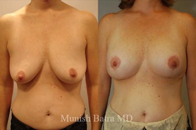 Breast Augmentation with Lift Mastopexy Before & After Gallery - Patient 209011 - Image 1