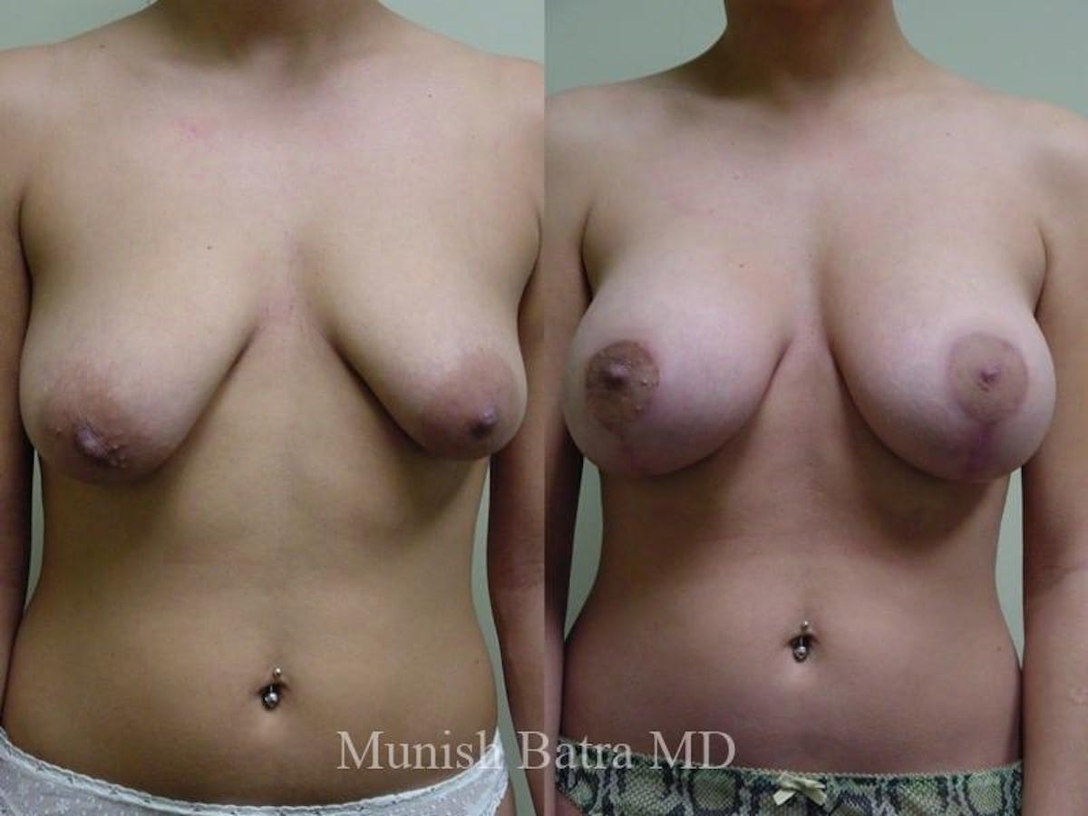 Breast Augmentation with Lift Mastopexy Before & After Gallery - Patient 411401 - Image 1