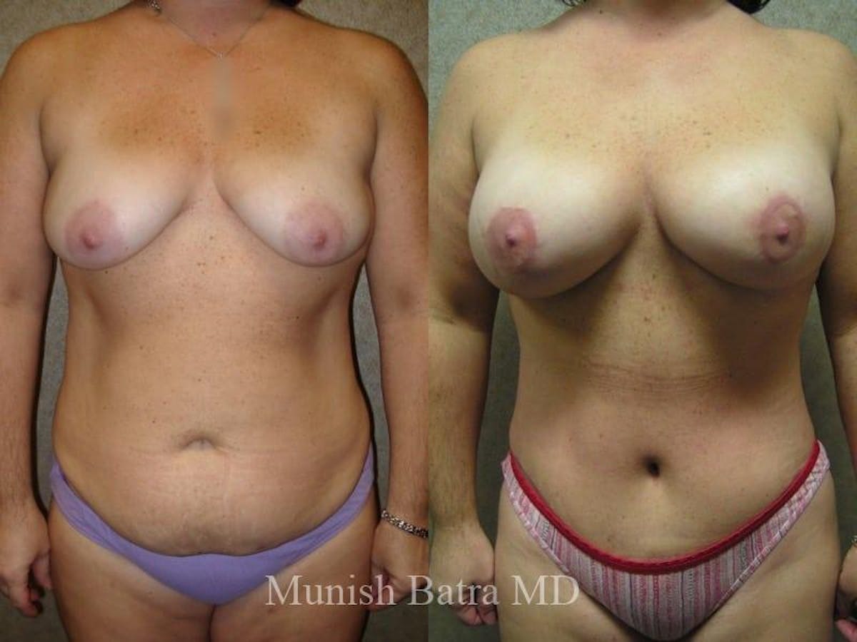 Breast Augmentation with Lift Mastopexy Before & After Gallery - Patient 376530 - Image 1