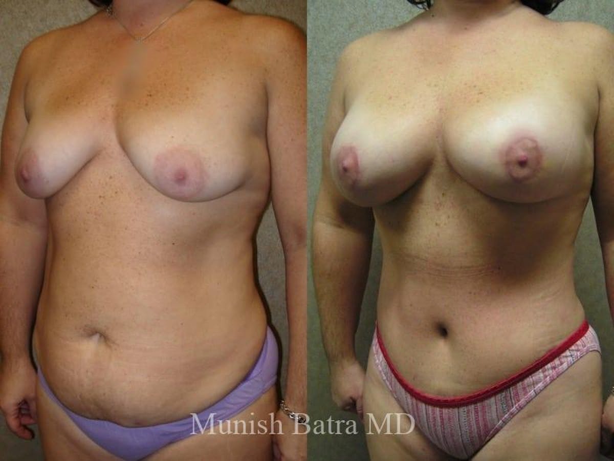 Breast Augmentation with Lift Mastopexy Before & After Gallery - Patient 376530 - Image 2
