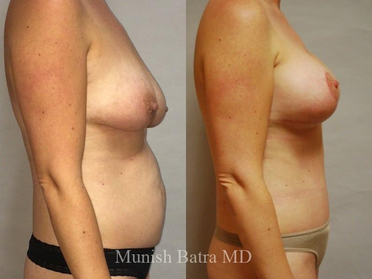 Breast Augmentation with Lift Mastopexy Before & After Gallery - Patient 859974 - Image 2