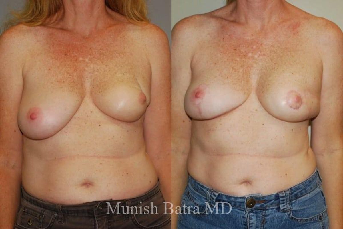 Breast Cancer Reconstruction Before & After Gallery - Patient 308263 - Image 1