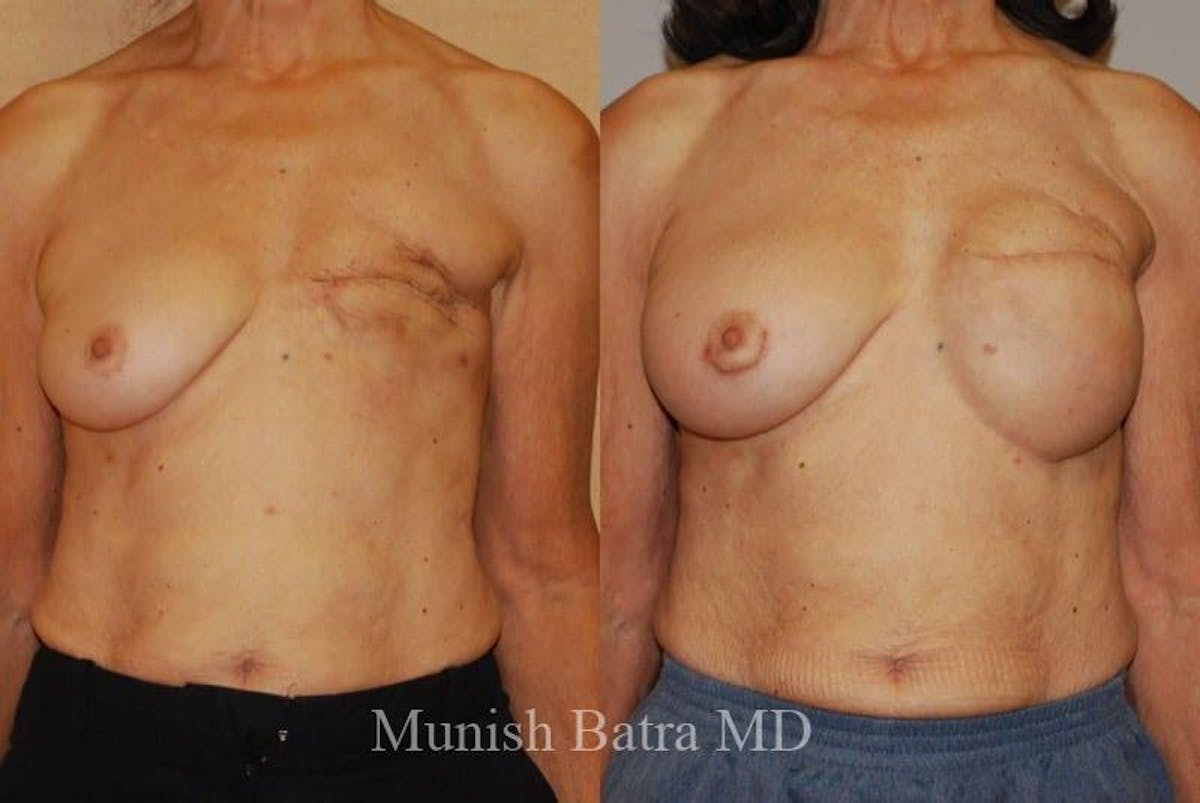 Breast Cancer Reconstruction Before & After Gallery - Patient 324499 - Image 1
