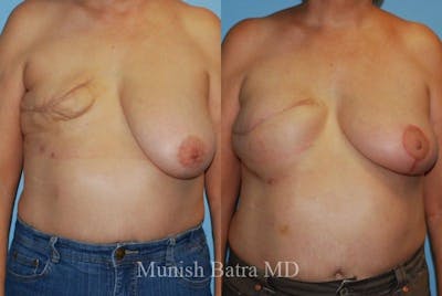 Breast Cancer Reconstruction Before & After Gallery - Patient 476616 - Image 1