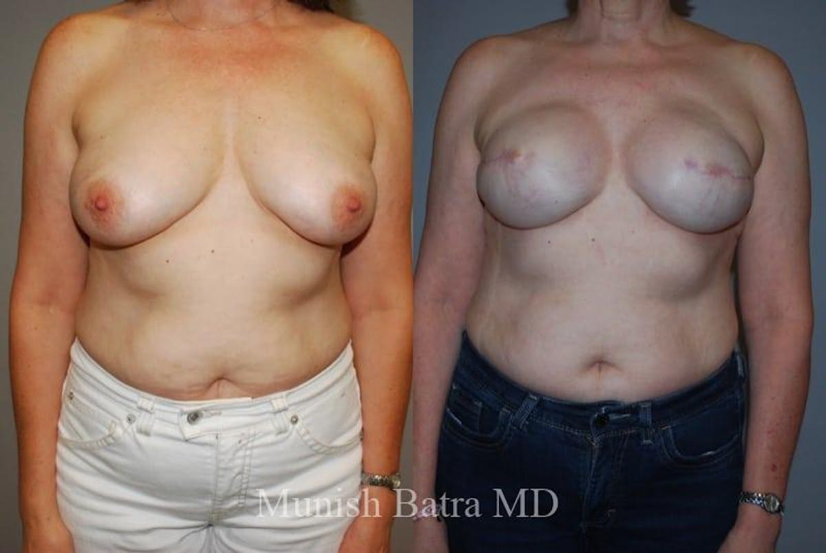 Breast Cancer Reconstruction Before & After Gallery - Patient 325093 - Image 1