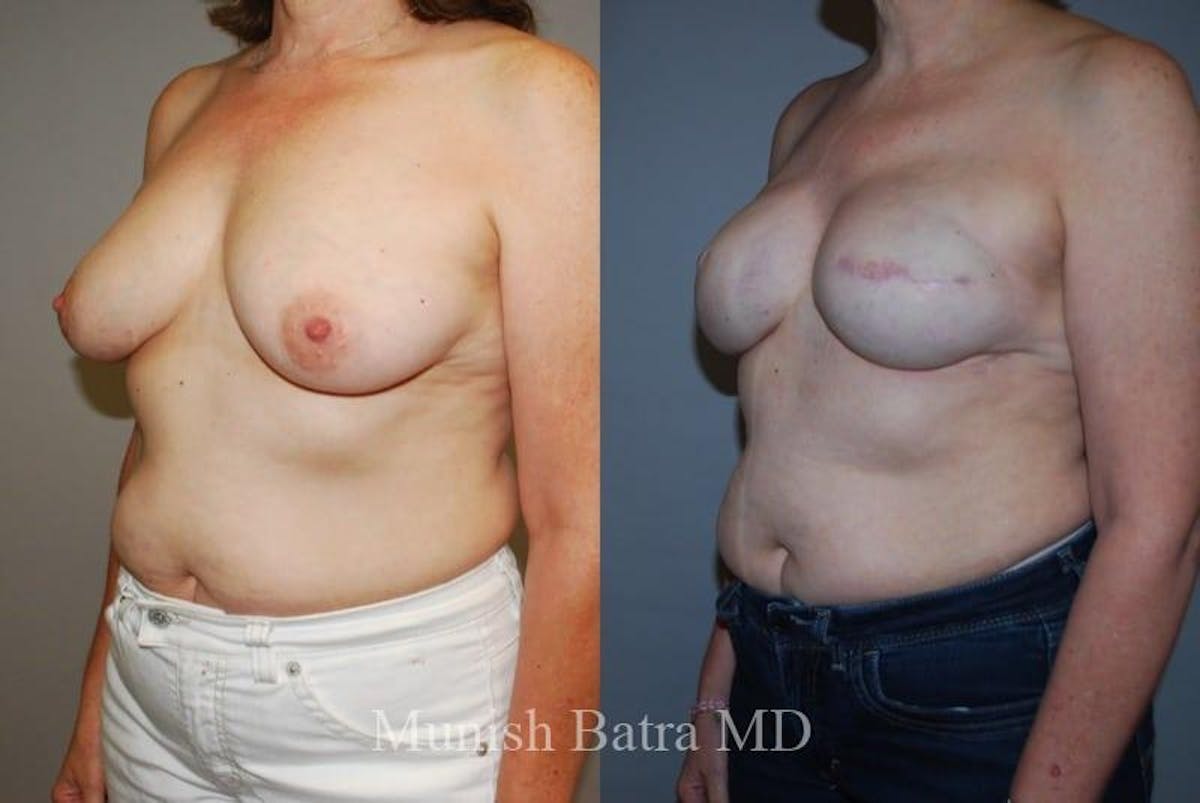 Breast Cancer Reconstruction Before & After Gallery - Patient 325093 - Image 2