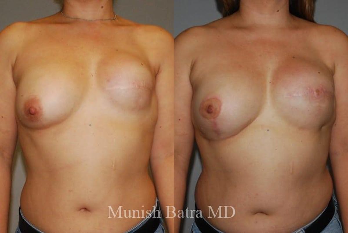 Breast Cancer Reconstruction Before & After Gallery - Patient 353120 - Image 1