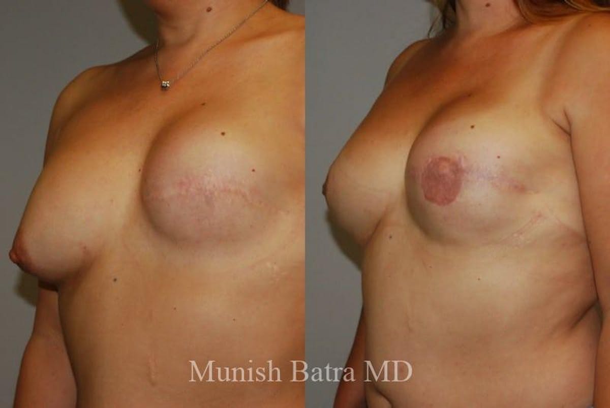 Breast Cancer Reconstruction Before & After Gallery - Patient 353120 - Image 2