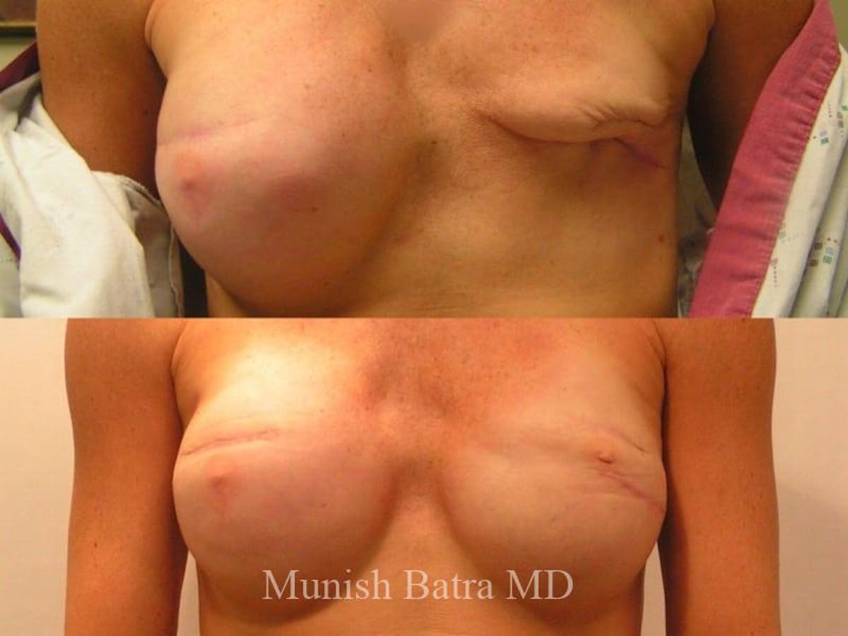 Breast Cancer Reconstruction Before & After Gallery - Patient 147794 - Image 1
