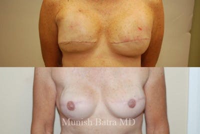 Breast Cancer Reconstruction Before & After Gallery - Patient 491950 - Image 1