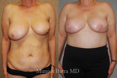 Breast Cancer Reconstruction Before & After Gallery - Patient 397301 - Image 1