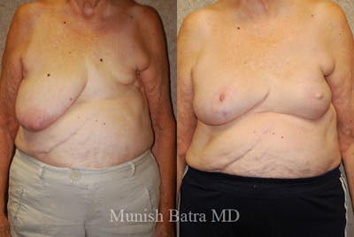Breast Cancer Reconstruction Before & After Gallery - Patient 575978 - Image 1