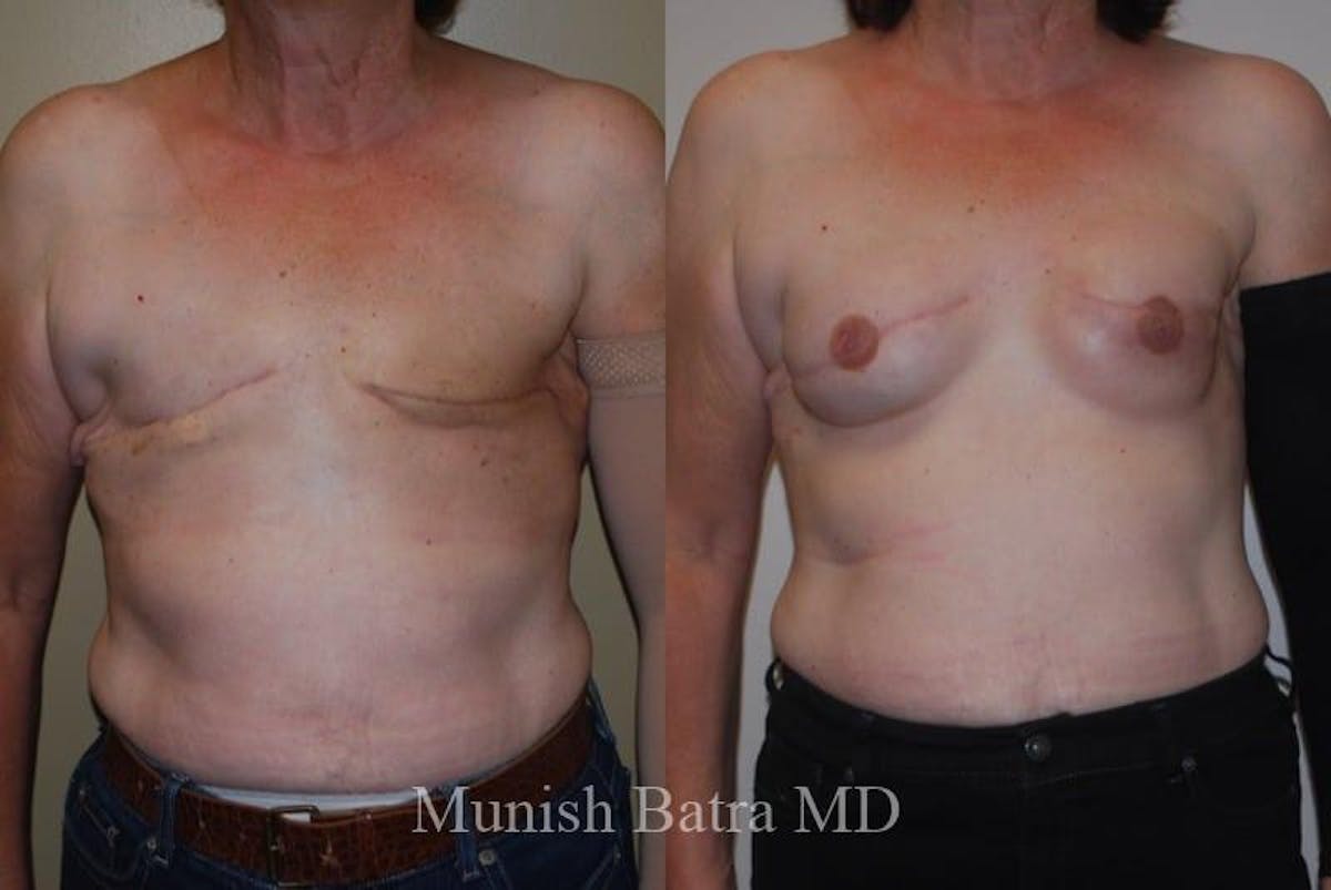 Breast Cancer Reconstruction Before & After Gallery - Patient 247180 - Image 1