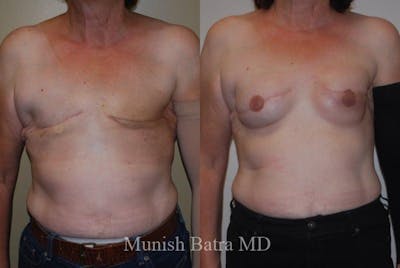 Breast Cancer Reconstruction Before & After Gallery - Patient 247180 - Image 1
