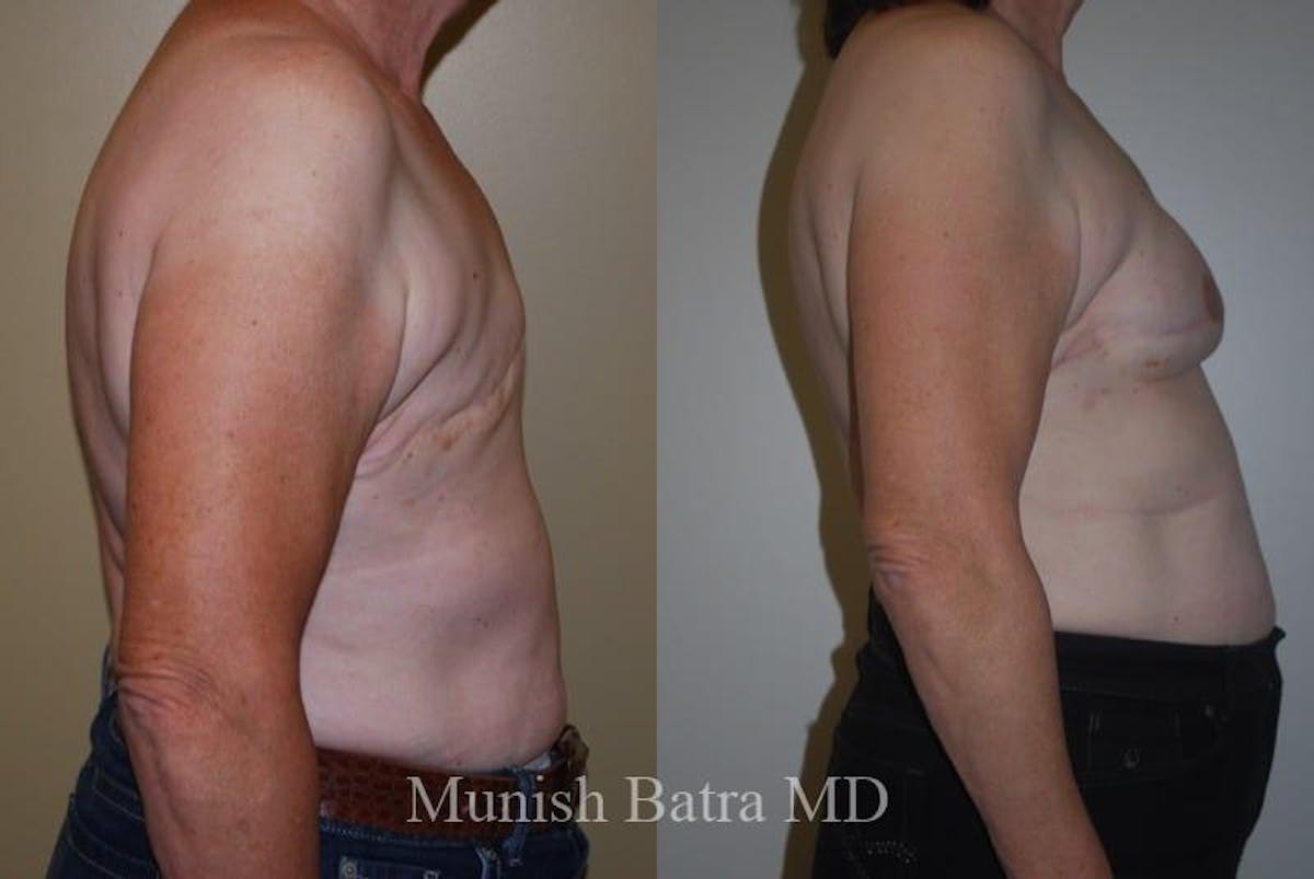 Breast Cancer Reconstruction Before & After Gallery - Patient 247180 - Image 2