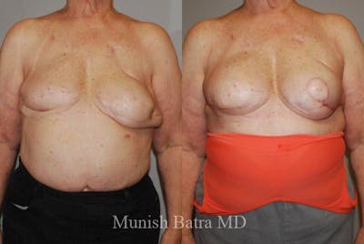 Breast Cancer Reconstruction Before & After Gallery - Patient 182571 - Image 1