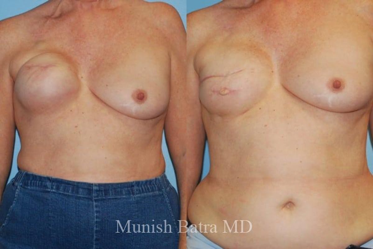 Breast Cancer Reconstruction Before & After Gallery - Patient 560496 - Image 1