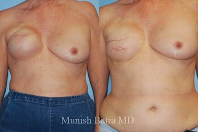 Breast Cancer Reconstruction Before & After Gallery - Patient 560496 - Image 1