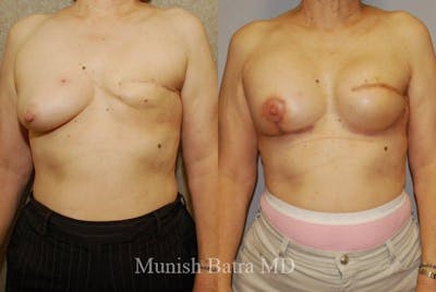 Breast Cancer Reconstruction Before & After Gallery - Patient 885477 - Image 1