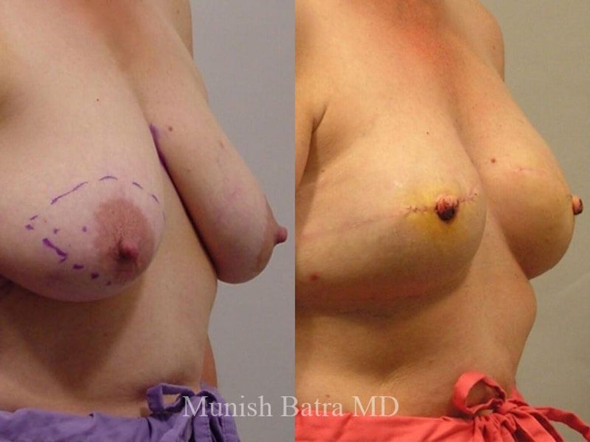 Breast Cancer Reconstruction Before & After Gallery - Patient 163043 - Image 1