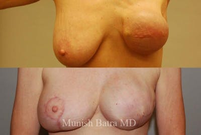 Breast Cancer Reconstruction Before & After Gallery - Patient 253506 - Image 1