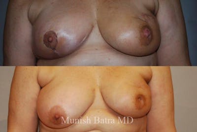 Breast Cancer Reconstruction Before & After Gallery - Patient 824724 - Image 1