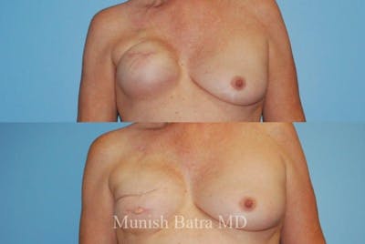 Breast Cancer Reconstruction Before & After Gallery - Patient 311166 - Image 1