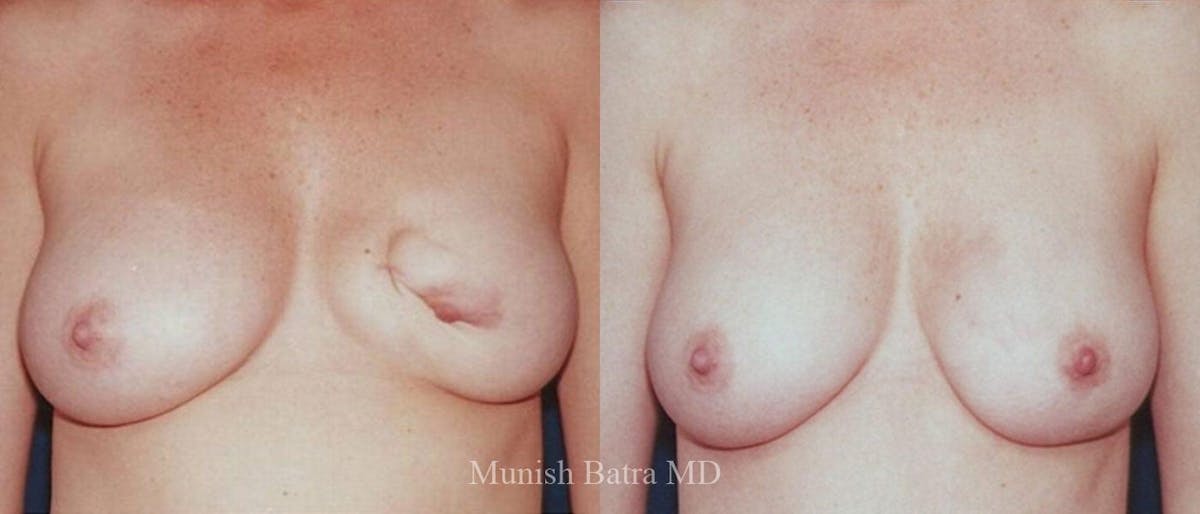 Breast Cancer Reconstruction Before & After Gallery - Patient 352302 - Image 1