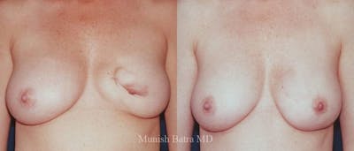 Breast Cancer Reconstruction Before & After Gallery - Patient 352302 - Image 1
