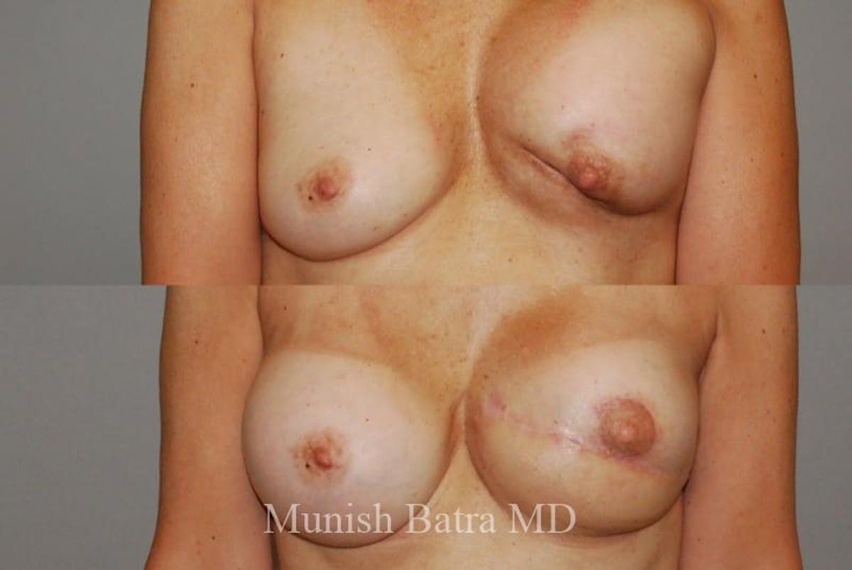 Breast Cancer Reconstruction Before & After Gallery - Patient 333495 - Image 1