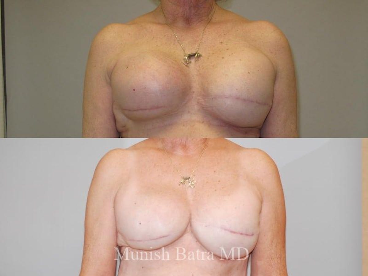 Breast Cancer Reconstruction Before & After Gallery - Patient 355985 - Image 1
