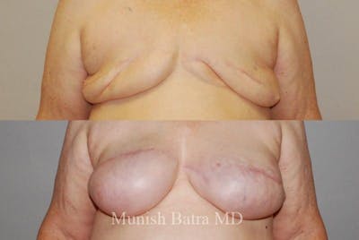 Breast Cancer Reconstruction Before & After Gallery - Patient 126050 - Image 1