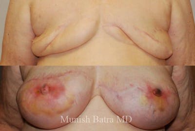 Breast Cancer Reconstruction Before & After Gallery - Patient 289780 - Image 1