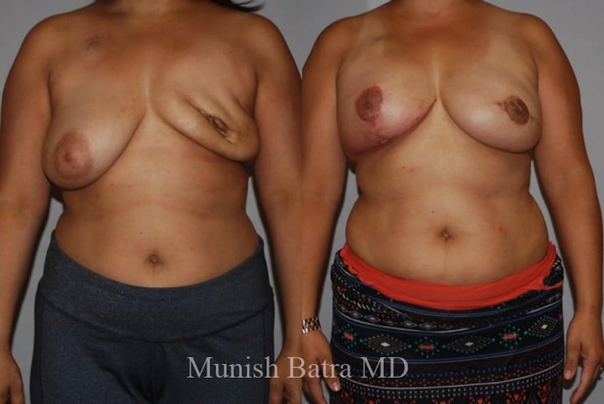 Breast Cancer Reconstruction Before & After Gallery - Patient 232293 - Image 1