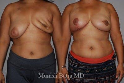 Breast Cancer Reconstruction Before & After Gallery - Patient 232293 - Image 1