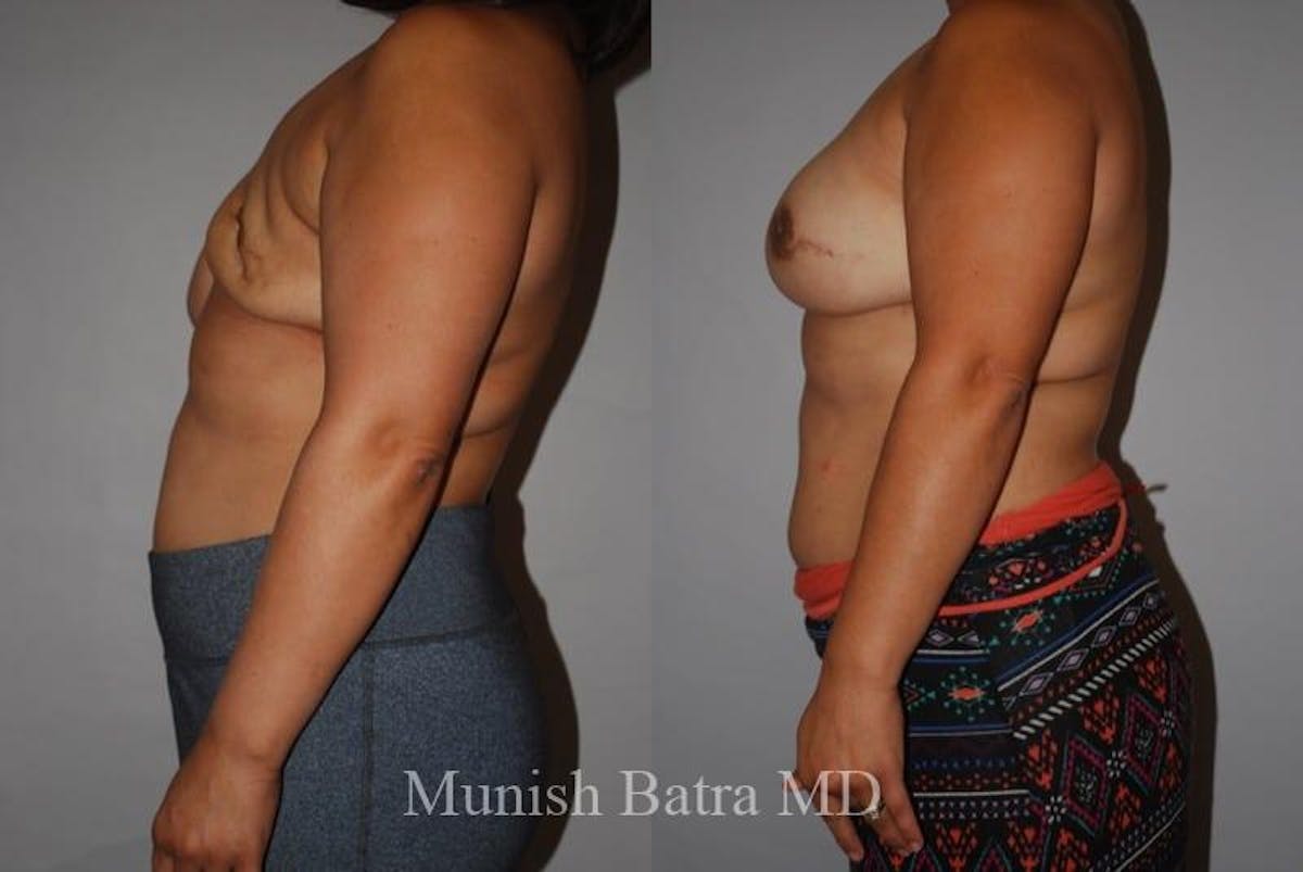 Breast Cancer Reconstruction Before & After Gallery - Patient 232293 - Image 2